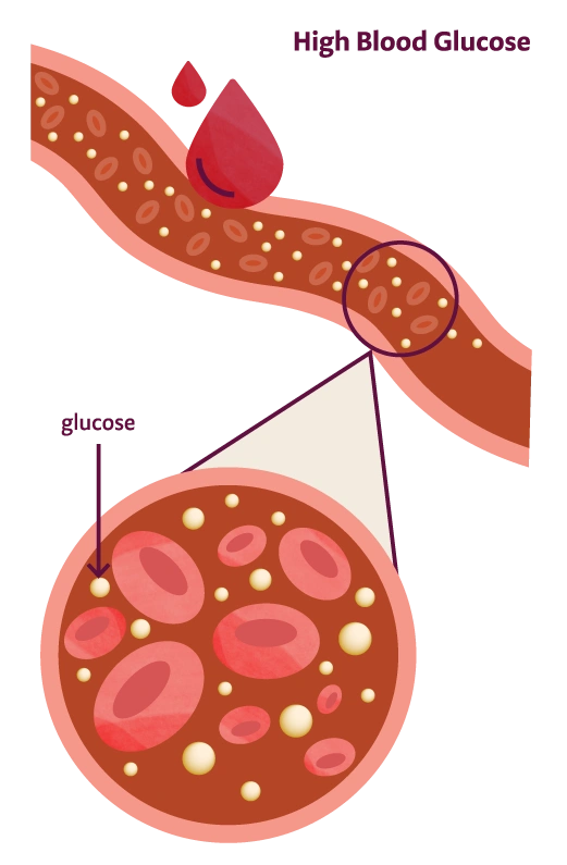 High Blood Glucose